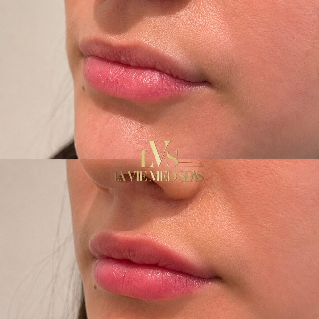 lip filler before and after treatment