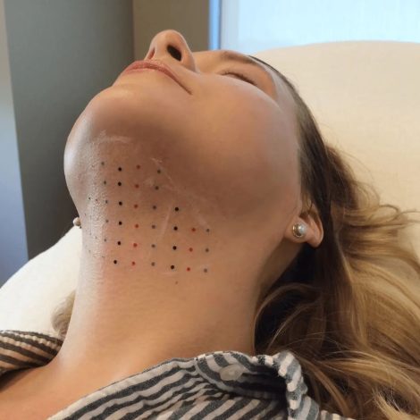 kybella chin sculpting