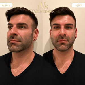 hair restoration before and after