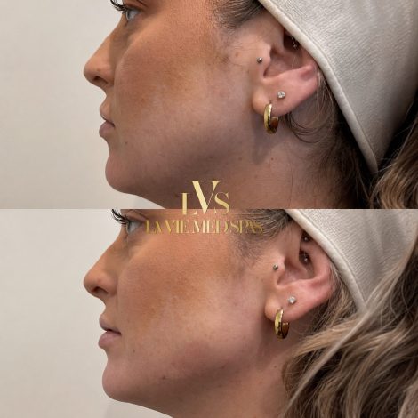 Jawline before and after treatment