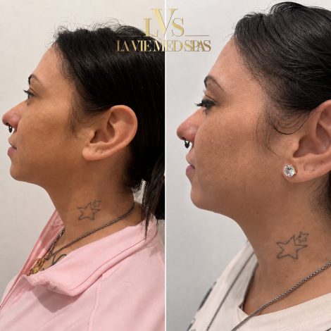 kybella before and after treatment