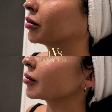Jawline Before and after
