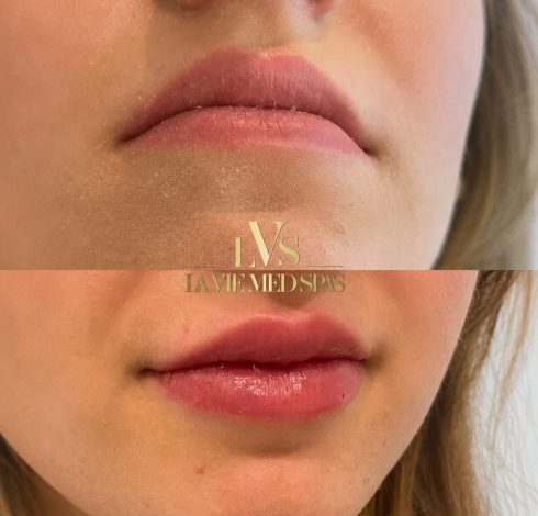 lip enhancement before and after