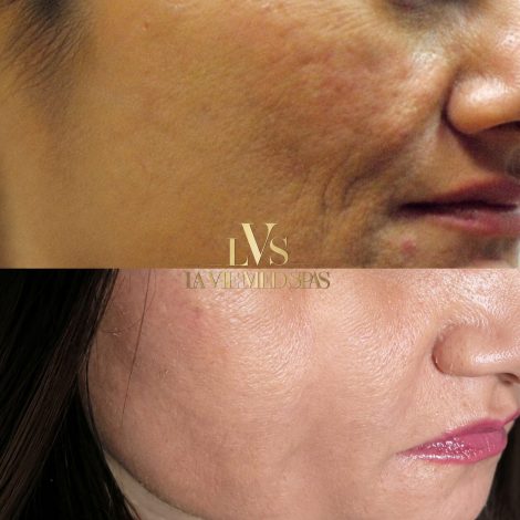 Belotero Balance® filler before and after