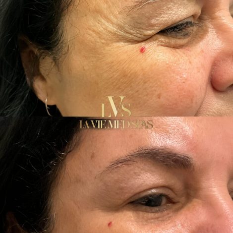 before and after fine lines