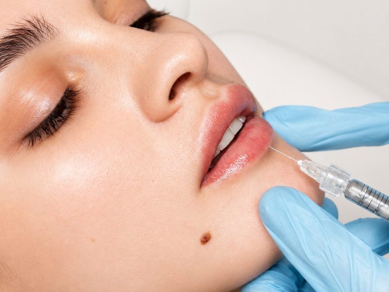 Close-up of cosmetic lip filler injection