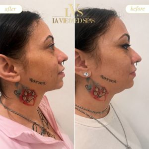kybella before and after