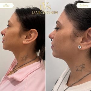 kybella before and after