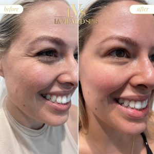 botox before and after