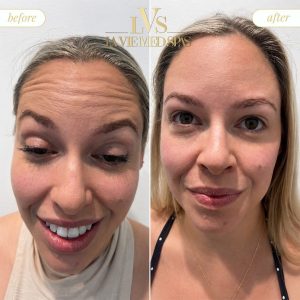 botox before and after