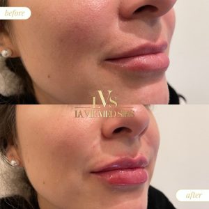 lip filler before and after