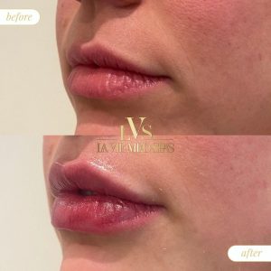 before and after lip filler