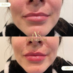 lip filler before and after