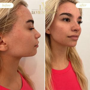 Jawline before and after treatment