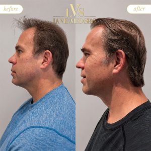 Jawline before and after treatment