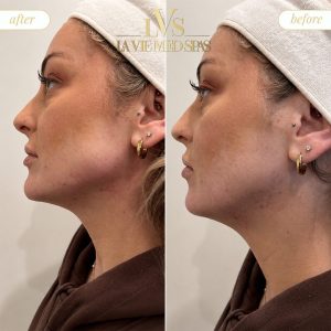 Jawline before and after treatment