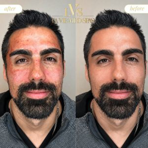 PRP with Microneedling Before and after
