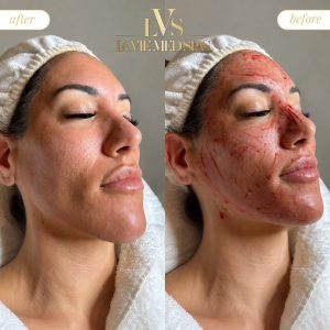 PRP with microneedline before and after