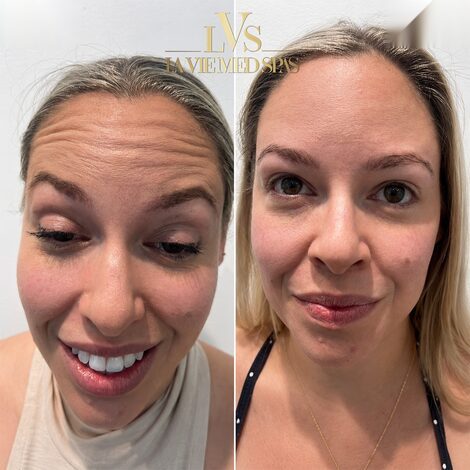 Wrinkle line before and after